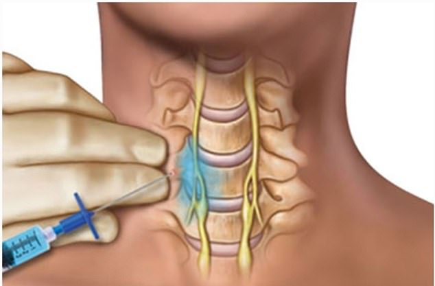 Doctors aren't sure why exactly this procedure was so effective at regaining the sense of smell, but there is a prevailing hypothesis that injecting and numbing some of the sympathetic nerve tissue recalibrates the body's nervous system to its pre-Covid state.  Photo courtesy of Nevada Comprehensive Pain Center