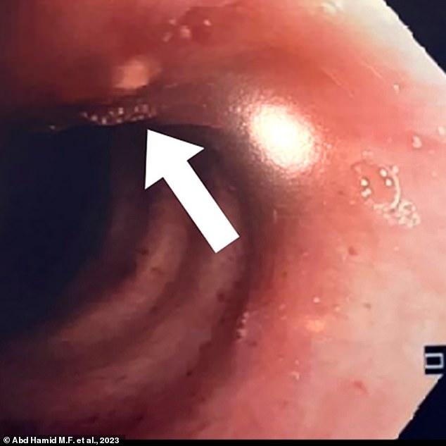 The above image shows the compression area on the woman's trachea.  It comes from a bronchoscopy, a procedure that looks at airways with a small camera on the end of a flexible tube.