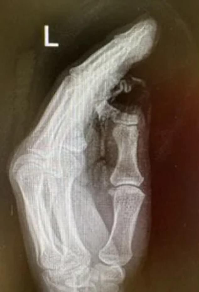 Mrs Parkinson held a wire that got stuck in the lawn mower blades and within seconds she cut her thumb in half (photo, x-ray of Mrs Parkinson)