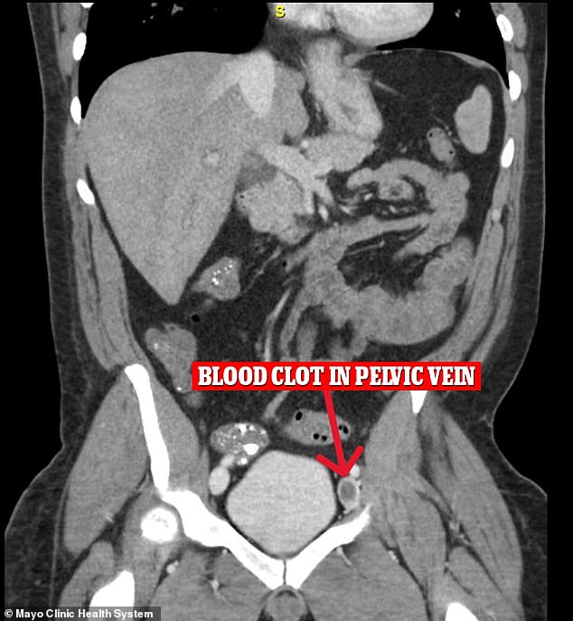 An additional CT scan of the man's pelvis also revealed deep vein thrombosis (DVT), a blood clot that has broken free from a deep vein in the leg or pelvis before traveling to the lungs.