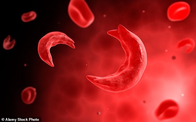 Patients with sickle cell disease, of which there are around 15,000 in Britain, do not properly produce hemoglobin – a substance in red blood cells, which transport oxygen around the body.  As a result, their red blood cells become stiff and form a crescent shape instead of a disk (pictured), which can cause them to die and become stuck in blood vessels.