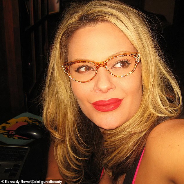 Krysta Carson (pictured) from Seattle, Washington used procedures like Botox for years without any problems