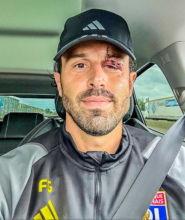 Fabio Grosso has since emerged after needing 13 stitches as a result of a shard of glass cutting his face