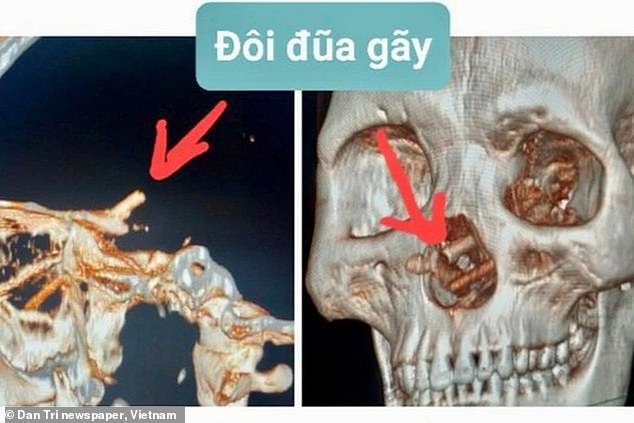 The CT scan of the 35-year-old man's skull shows chopsticks protruding from his nose.  The stuck chopsticks caused him to develop severe headaches and fluid discharge