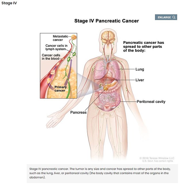 And in stage four, it begins to spread through the bloodstream to other parts of the body