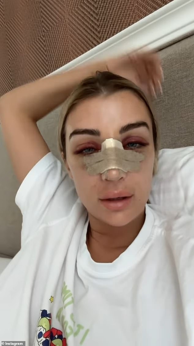 The Gold Coast reality star flew to Turkey this week to have her nose done and posted photos of herself with bruised skin and bandages on her face