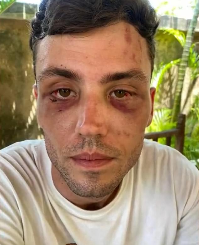 Australian tourist Matthew Stevenson (pictured) was left bloodied and bruised when he was brutally beaten in Bali for dancing with the wrong woman