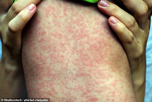 The paramyxovirus family has more than 75 viruses, including mumps, measles and respiratory infections.  Measles causes horrific skin rashes (photo)