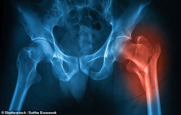 Injuries such as hip fractures (pictured) can cause complications such as heart problems.  The Royal Osteoporosis Society (ROS) claims the deaths are the result of a postcode lottery in NHS hospital trust bone screening services