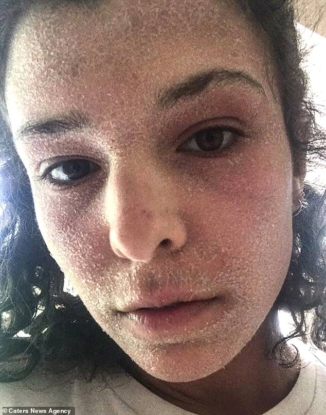 Alice, 23, ditched the steroid creams she used for her eczema in April this year.  As a result, she suffered from withdrawal symptoms, which made her skin even worse (pictured)