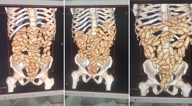 X-rays taken of three of six Nigerian men arrested Tuesday at Guarulhos International Airport in São Paulo, Brazil for having cocaine capsules in their stomachs