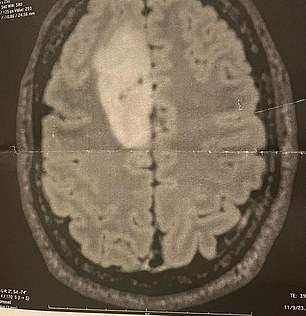 Scans: A glioma is 