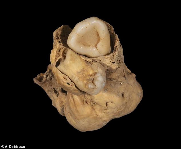 The growth, measuring three centimeters by two centimeters long, was lodged in the pelvic bone, where researchers discovered teeth with distinctive crowns covered in enamel.