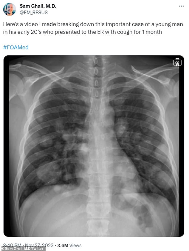 Dr.  Sam Ghali, a Florida-based emergency physician, discussed the case of a young man in his 20s who did not realize until it was too late that he had advanced testicular cancer, which manifested in the formation of nodules of cancer cells in the lungs.  in the shape of cannonballs