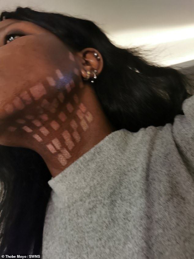 She was assigned an intern and the treatment on the left side of her neck quickly became painful and she felt an 'intense and unfamiliar burning sensation'.