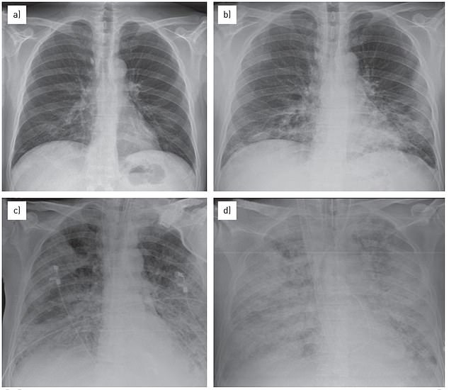 The above image shows the lungs during 'white lung syndrome' or acute respiratory distress syndrome, which is diagnosed via the white spots or opaque areas that appear in the lungs.  The above patient was a 57-year-old man in 2014