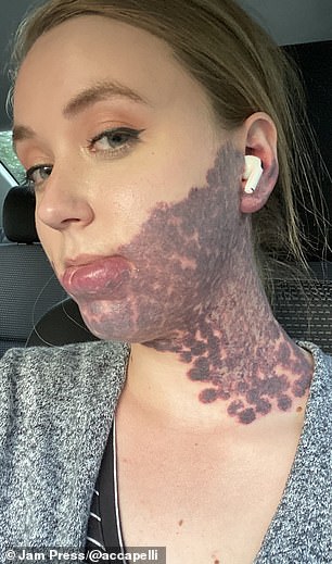 She has openly shared her journey with laser surgery to help clear up the redness.  The photo shows her immediately after surgery, before her skin started to heal