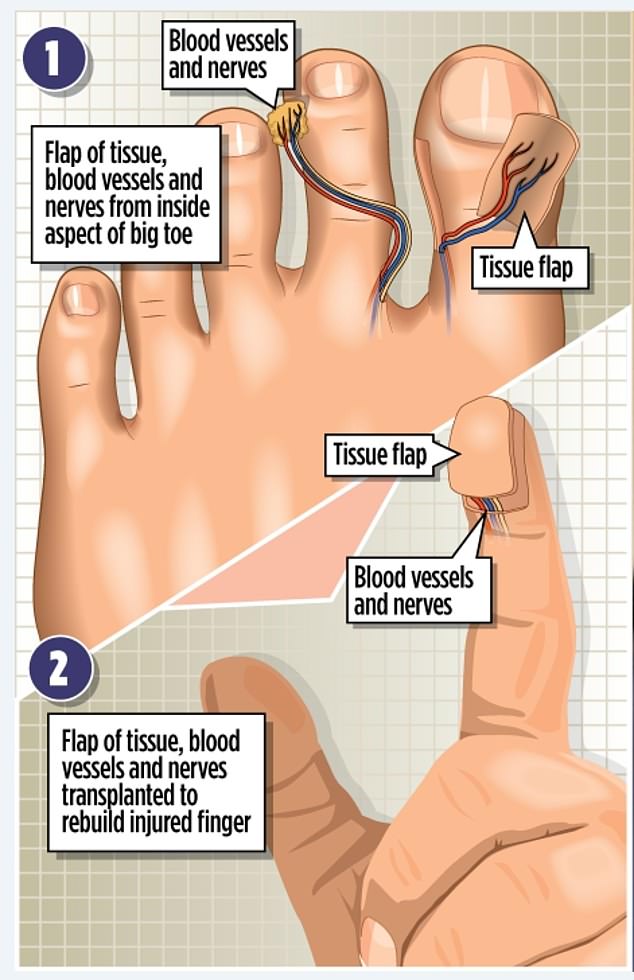 During the complex operation, surgeons took a one-square-centimeter sample of tissue from the inside of the big toe, along with blood vessels from another part of the foot.