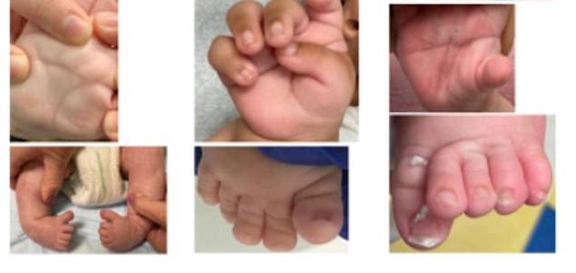 Several babies had fused toes and rounded 'rocker bottom' feet