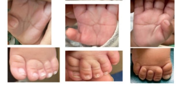 Some babies also had wider thumbs than normally seen, as well as a single horizontal crease in their palms, as opposed to the normal two.