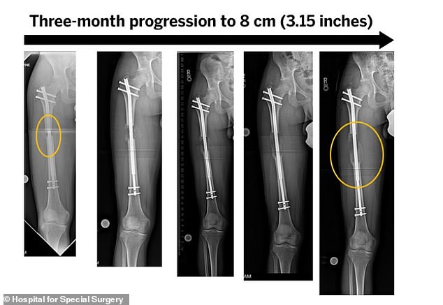 A three-month progression from the Hospital for Special Surgery in New York City shows gradual lengthening of the femur, or femur.  The circled opening shows the new bone growth