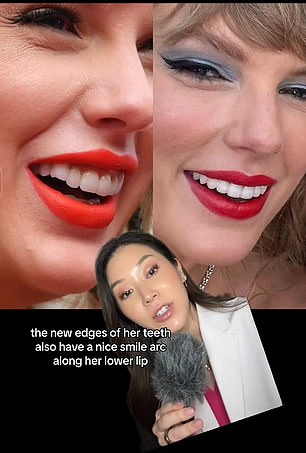 Dr.  Kahng suggests Taylor got new veneers covering her chipped tooth (left)