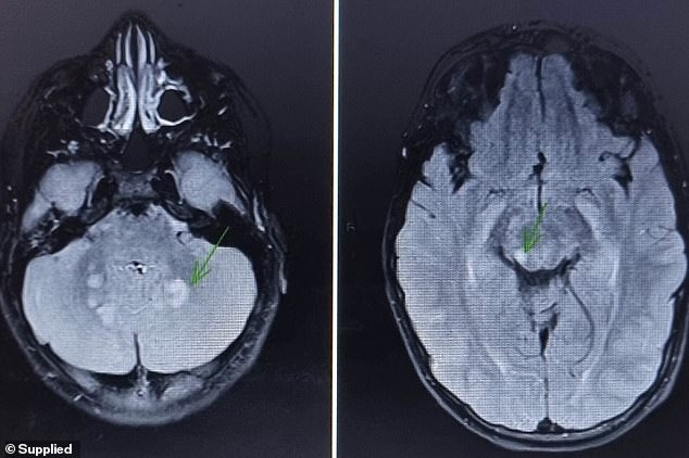 He has a few tumors in his brain and behind his eyes (photo).  The largest tumor on his spine is 13 cm in size