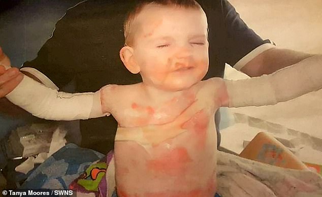 Rhys was born with the skin condition, meaning his skin is so thin that the slightest impact can be life-changing