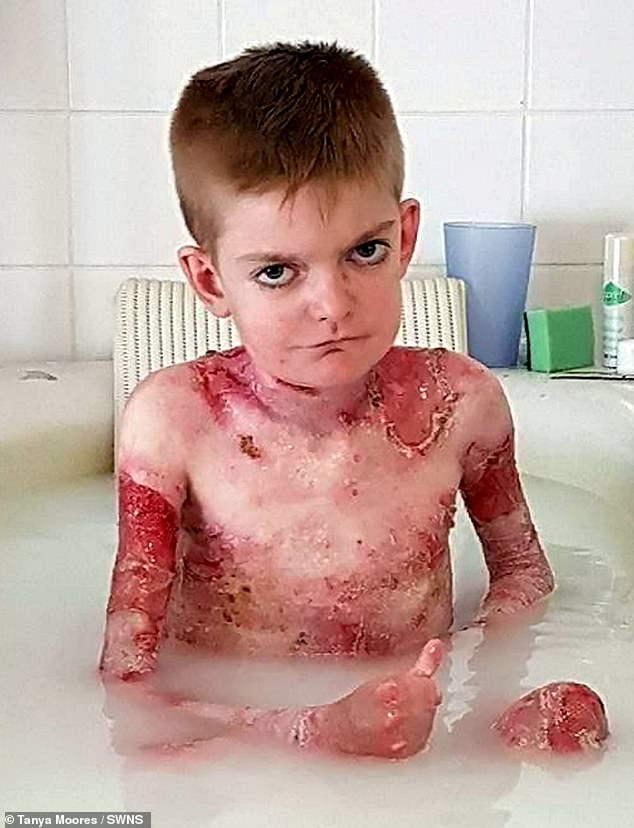 The brave teenager has open wounds on 50 percent of his body at any time and is constantly taking antibiotics