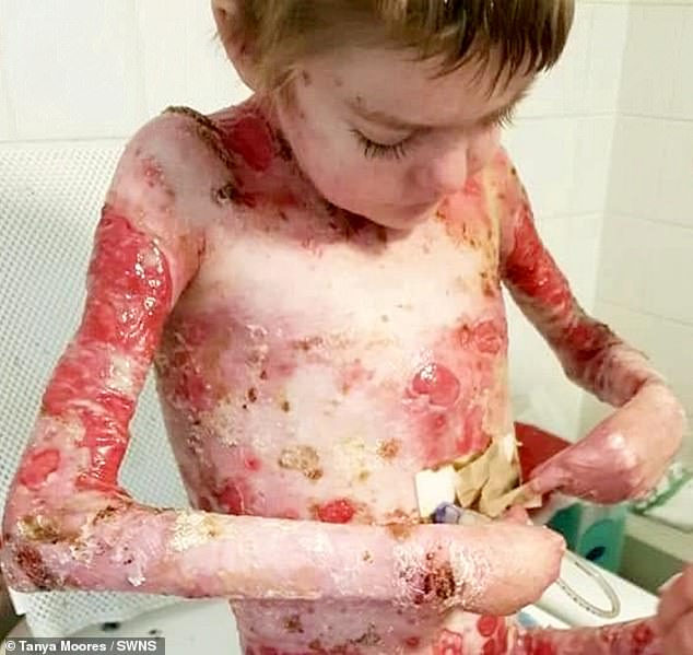 Rhys' condition means that the slightest impact on the skin can cause painful blisters to form