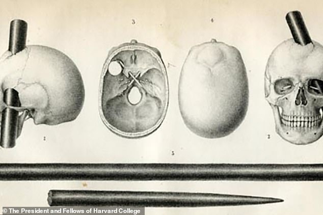 Sketches show how a metal rod shot through Phineas Gage's skull, destroying much of his frontal lobe and completely changing his personality