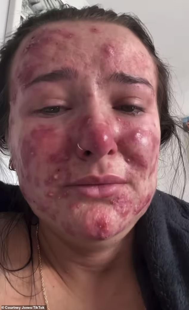 She's struggled with acne since she was a teenager, but after enduring years of painful breakouts, she's risen to internet stardom by documenting her skincare journey