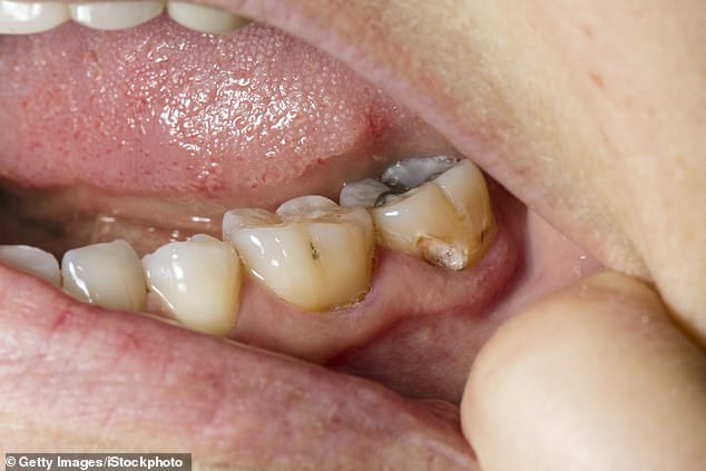 Without access to fillings or root canals, there is also evidence that they attempted to 'drill' their own teeth, using tools to make holes.  Many were even forced to pull teeth to cope with the pain (file image)