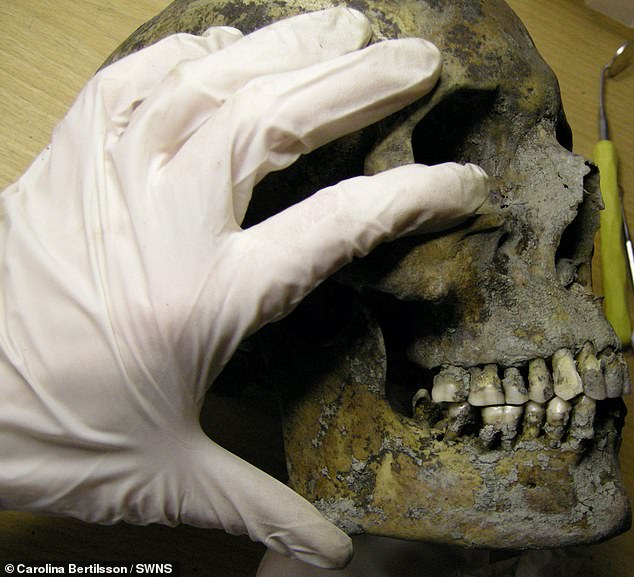 Researchers found that almost two-thirds of Viking adults had at least one cavity in their teeth (Photo: A researcher examining a Viking's jaw and teeth)