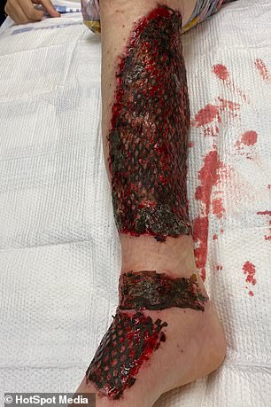 Kendra's right leg pictured after surgery while she was recovering