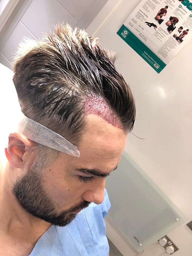 NO PAIN, NO GAIN: Doctors graft hair follicles onto model Paul Knops' scalp