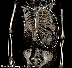 Scans of the mummy showed another fetus stuck in the chest cavity