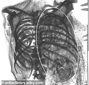 A CT scan identified the child within the upper left chest cavity of the mummy, and showed long bones, ribs, neural arches, a skull, and five hand bones.