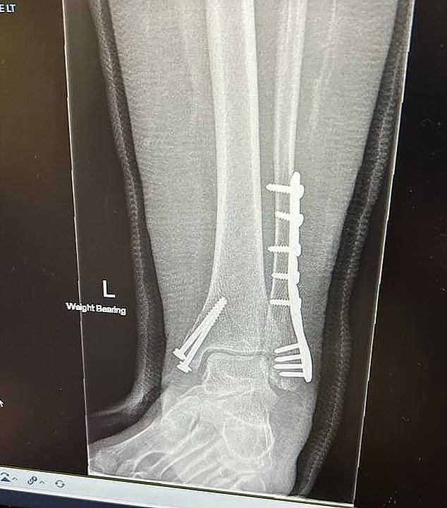 Scans show Donowho's ankle after the crash