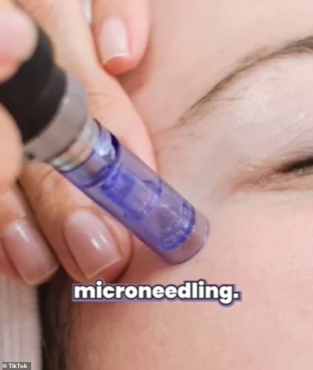 Dr.  Turegano also suggested microneedling, used to stimulate collagen production in the face, as another simple procedure with little recovery time.