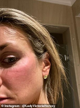 The former It girl 'couldn't keep quiet any longer' and posted photos of Isabella's injuries on Instagram in December (photo: Isabella with bruise)