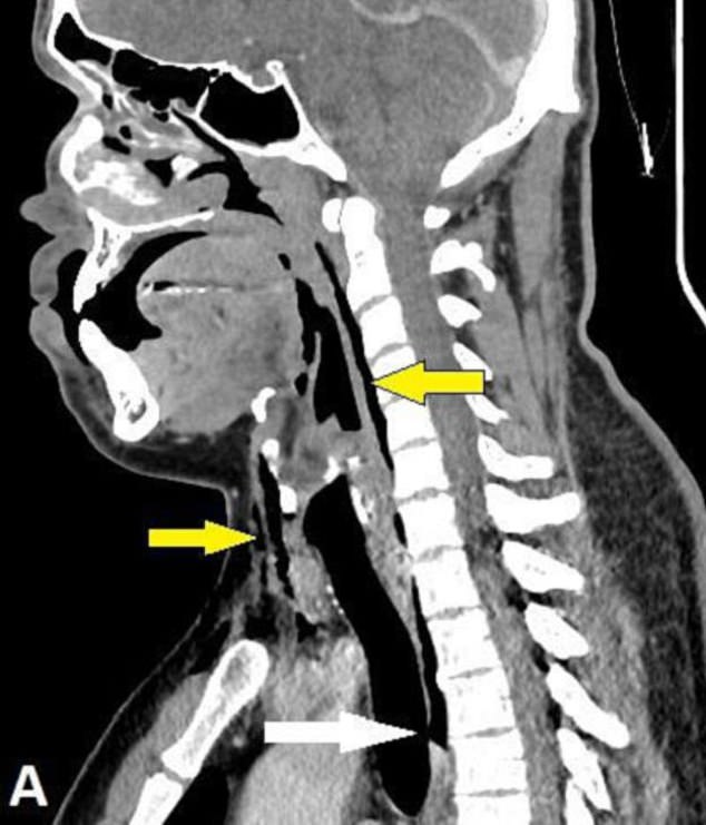 A CT scan of the man's neck revealed air concentrations in surrounding tissues due to the tear, which is what the white arrow points to