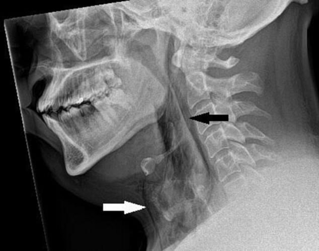 The scan shows air trapped in tissues in the neck, causing a potentially dangerous tear in the trachea