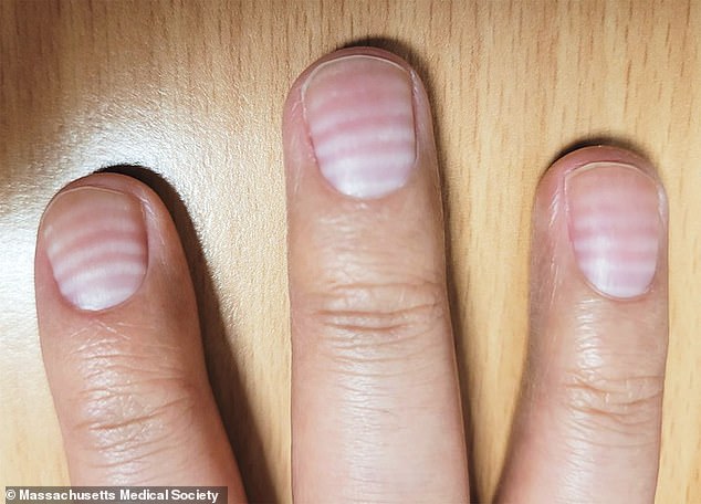Upon examining the patient's nails, doctors saw six horizontal lines across the nails of both hands and diagnosed transverse leukonychia, also known as Mees' lines.