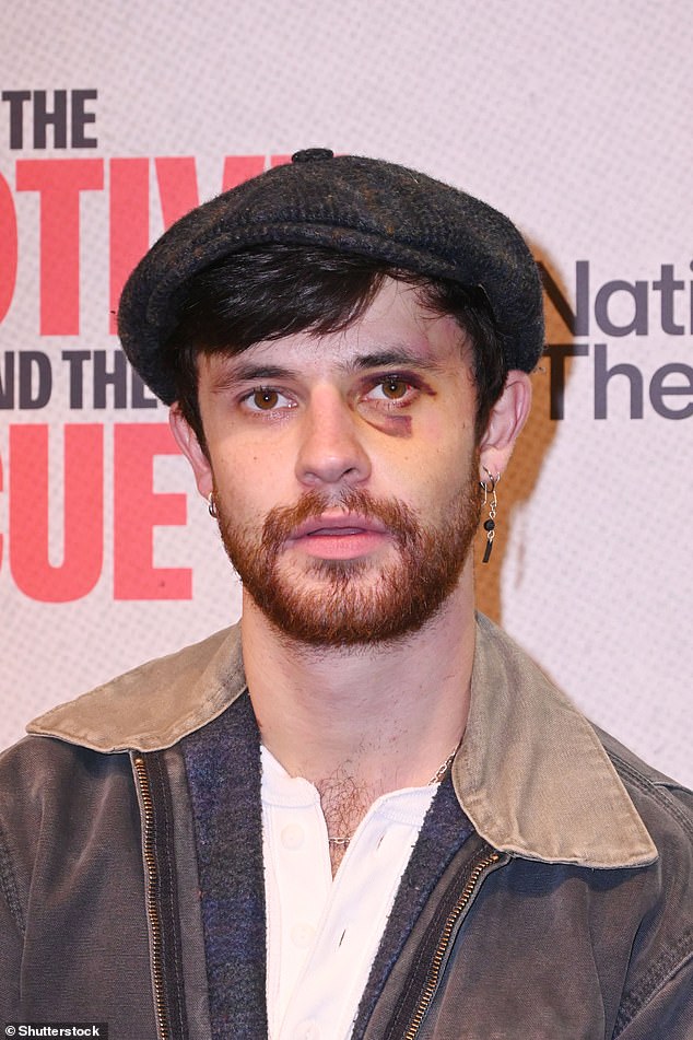 Cel Spellman suffered a nasty black eye on Monday while attending the opening night of The Motive and the Cue at the Noel Coward Theater