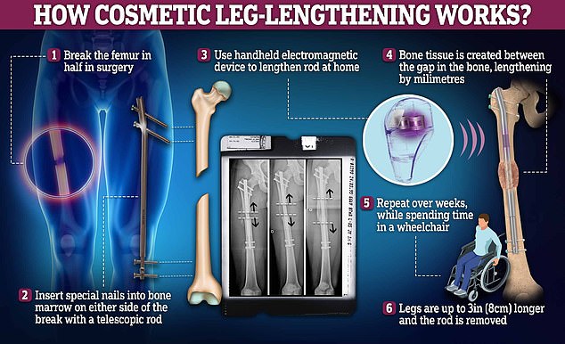 The amazing procedure works by breaking at least two leg bones in half.  Nails are then drilled into both ends of each femur and shin bone, which are slowly pulled apart with magnets, resulting in a longer bone over a period of a few weeks.  But it can leave patients in pain and wheelchair-bound during the process, requiring months of physical therapy