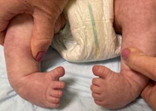 Several babies had 'rocking feet' characterized by a curved appearance that resembled the feet that give a rocking chair its distinctive quality