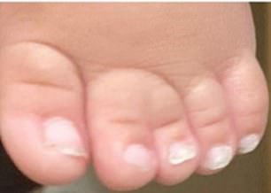 Several of the babies' toes had webbed feet