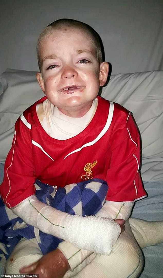 Rhys Williams (pictured), 18, from Bolton, was born with a serious skin condition called epidermolysis bullosa and has been given just days to live after being diagnosed with sepsis