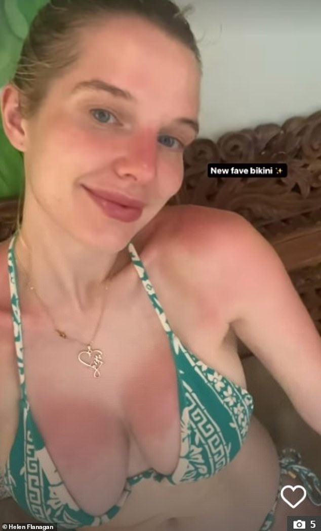 Helen Flanagan sparked concern among her fans when she showed off her badly sunburned chest while posing in a bikini during her Bali getaway